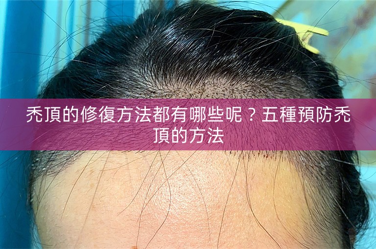 禿頂的修復方法都有哪些呢？五種預防禿頂的方法