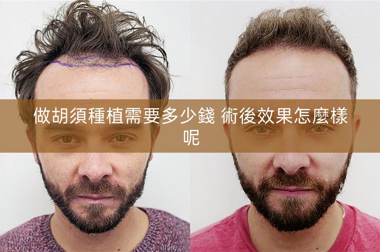 做胡須種植需要多少錢 術後效果怎麼樣呢 做胡須種植需要多少錢 術後效果怎麼樣呢