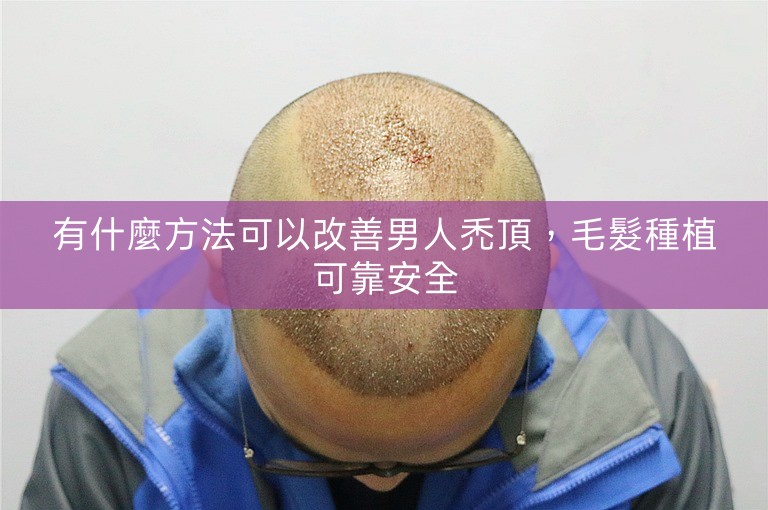 有什麼方法可以改善男人禿頂，毛髮種植可靠安全