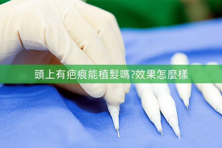 頭上有疤痕能植髮嗎?效果怎麼樣