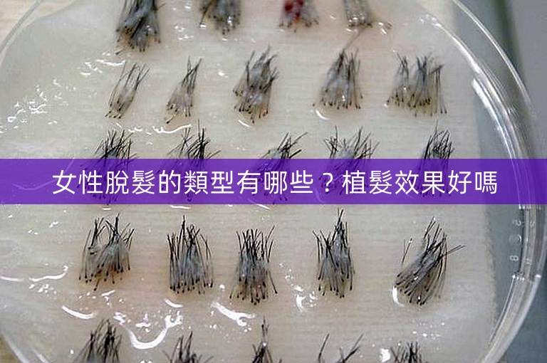 女性脫髮的類型有哪些?植髮效果好嗎 女性脫髮的類型有哪些?植髮效果好嗎