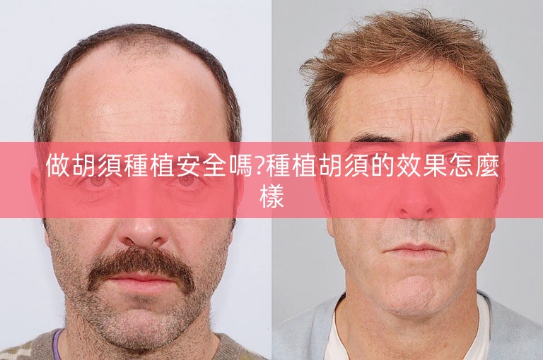 做胡須種植安全嗎?種植胡須的效果怎麼樣 做胡須種植安全嗎?種植胡須的效果怎麼樣