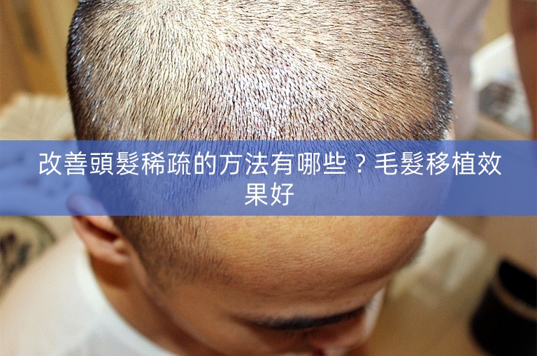 改善頭髮稀疏的方法有哪些？毛髮移植效果好