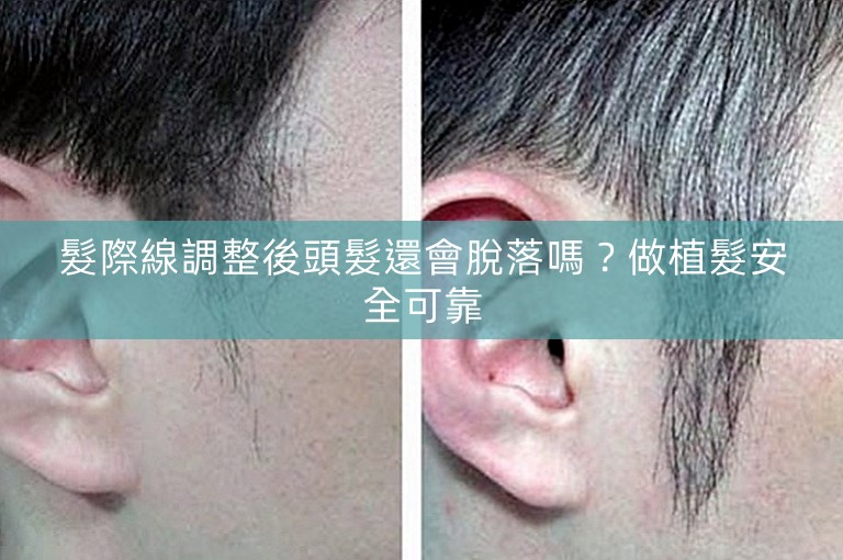 髮際線調整後頭髮還會脫落嗎？做植髮安全可靠