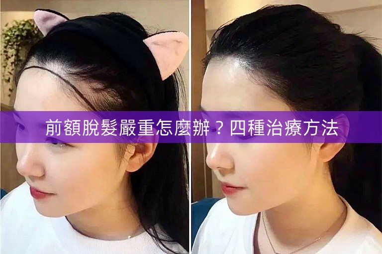 前額脫髮嚴重怎麼辦？四種治療方法