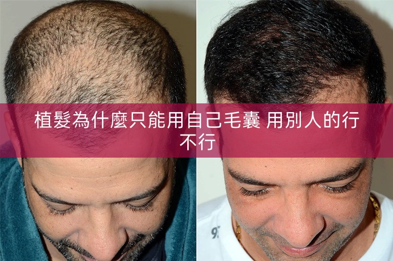 植髮為什麼只能用自己毛囊 用別人的行不行