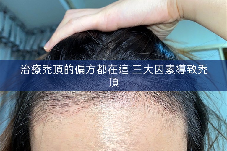 治療禿頂的偏方都在這 三大因素導致禿頂