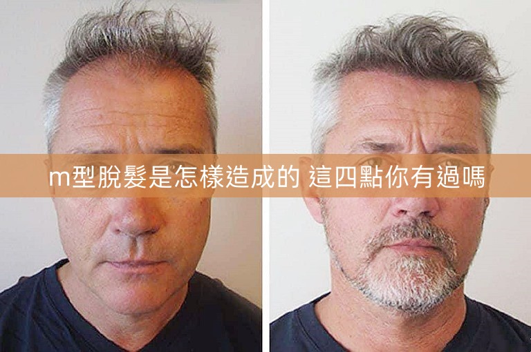 m型脫髮是怎樣造成的 這四點你有過嗎