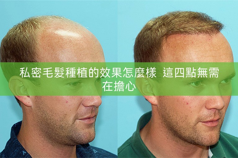私密毛髮種植的效果怎麼樣  這四點無需在擔心