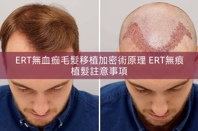 ERT無血痂毛髮移植加密術原理 ERT無痕植髮註意事項