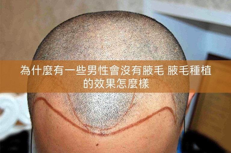 為什麼有一些男性會沒有腋毛 腋毛種植的效果怎麼樣 為什麼有一些男性會沒有腋毛 腋毛種植的效果怎麼樣