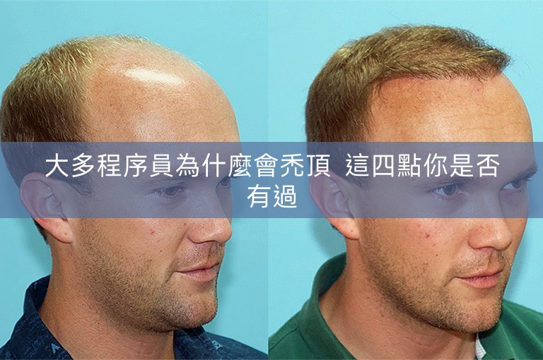 大多程序員為什麼會禿頂  這四點你是否有過