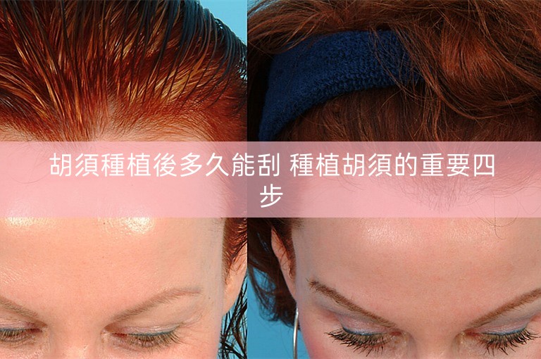 胡須種植後多久能刮 種植胡須的重要四步