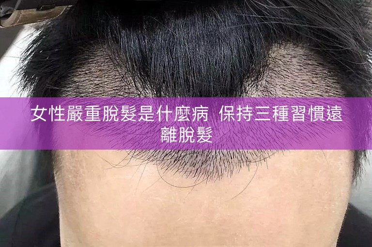 女性嚴重脫髮是什麼病 保持三種習慣遠離脫髮 女性嚴重脫髮是什麼病 保持三種習慣遠離脫髮