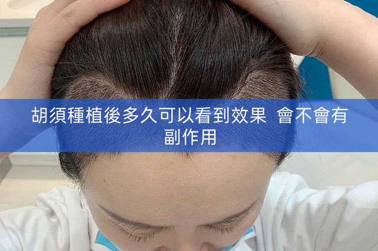 胡須種植後多久可以看到效果 會不會有副作用 胡須種植後多久可以看到效果 會不會有副作用