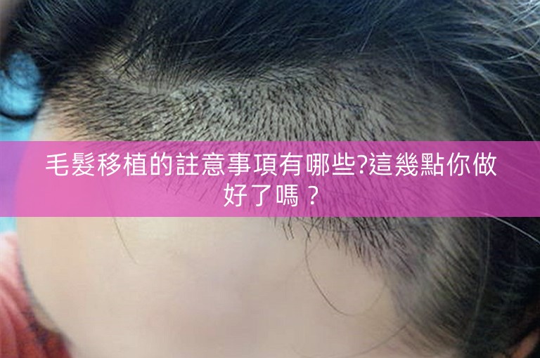 毛髮移植的註意事項有哪些?這幾點你做好了嗎？