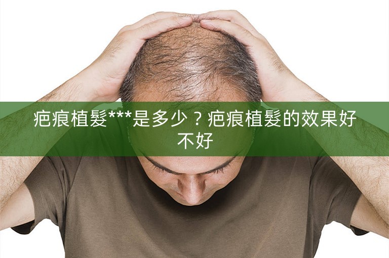 疤痕植髮***是多少?疤痕植髮的效果好不好 疤痕植髮***是多少?疤痕植髮的效果好不好