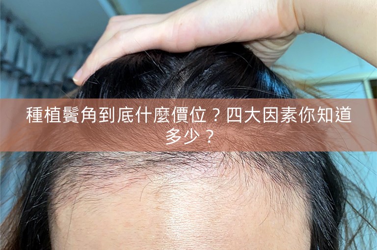 種植鬢角到底什麼價位？四大因素你知道多少？