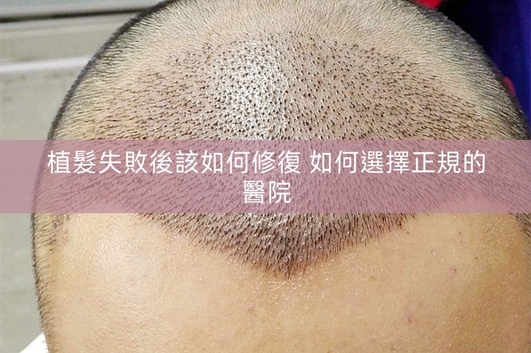 植髮失敗後該如何修復 如何選擇正規的醫院