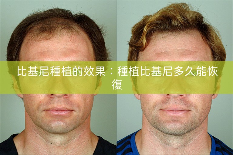 比基尼種植的效果:種植比基尼多久能恢復 比基尼種植的效果:種植比基尼多久能恢復