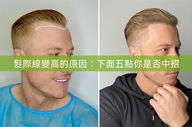 髮際線變高的原因:下面五點你是否中招 髮際線變高的原因:下面五點你是否中招