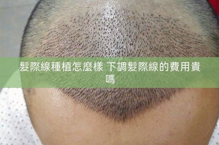 髮際線種植怎麼樣 下調髮際線的費用貴嗎