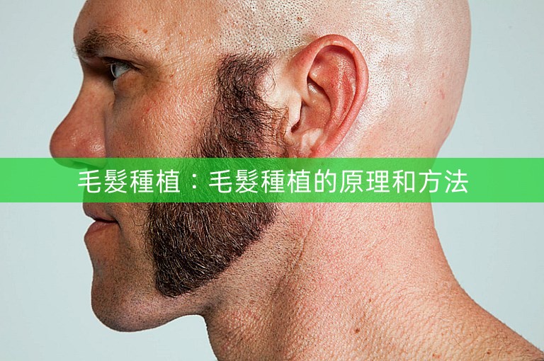 毛髮種植:毛髮種植的原理和方法 毛髮種植:毛髮種植的原理和方法