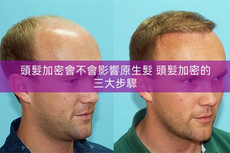 頭髮加密會不會影響原生髮 頭髮加密的三大步驟