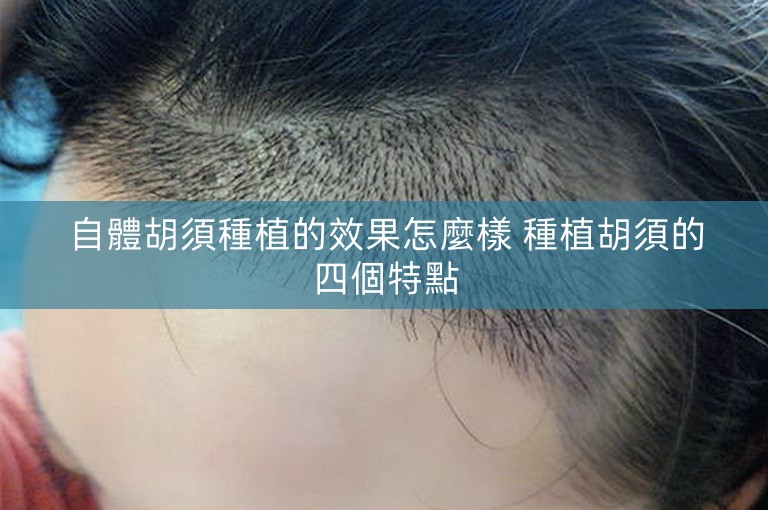 自體胡須種植的效果怎麼樣 種植胡須的四個特點