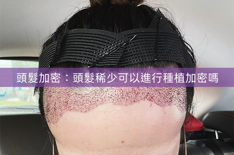 頭髮加密：頭髮稀少可以進行種植加密嗎