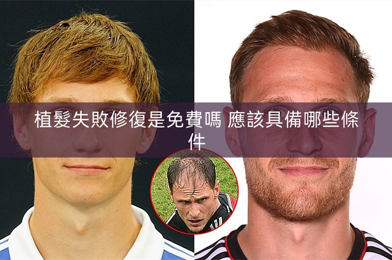 植髮失敗修復是免費嗎 應該具備哪些條件