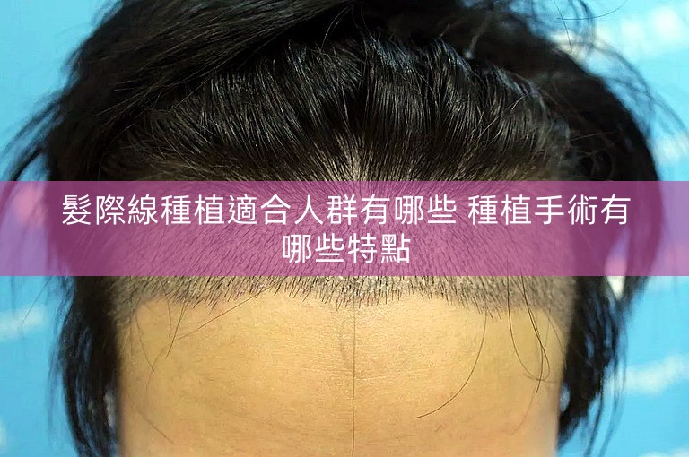 髮際線種植適合人群有哪些 種植手術有哪些特點