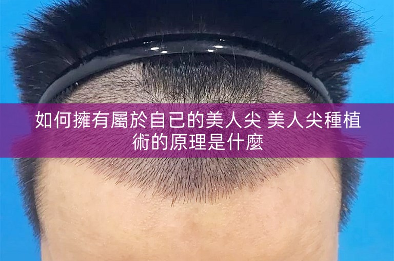 如何擁有屬於自已的美人尖 美人尖種植術的原理是什麼