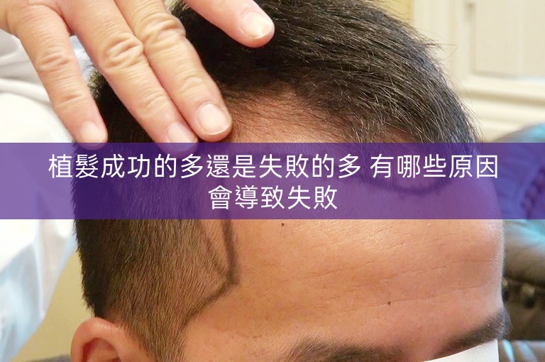 植髮成功的多還是失敗的多 有哪些原因會導致失敗
