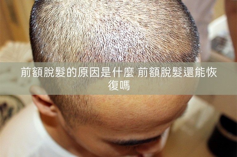 前額脫髮的原因是什麼 前額脫髮還能恢復嗎