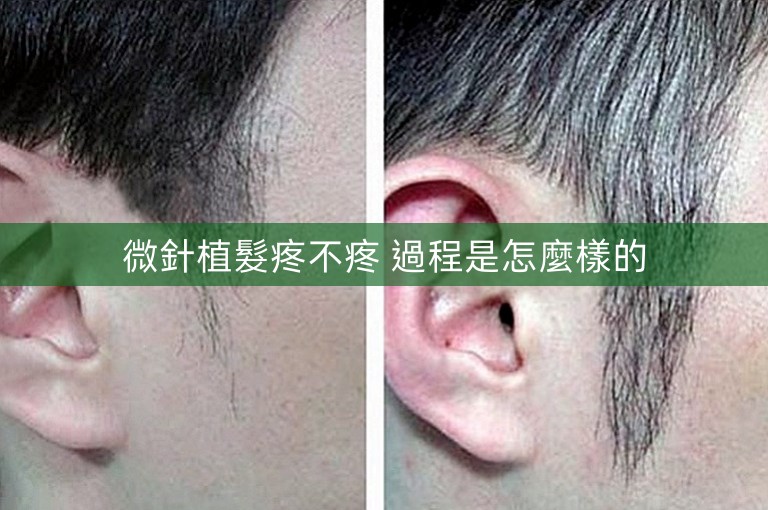 微針植髮疼不疼 過程是怎麼樣的
