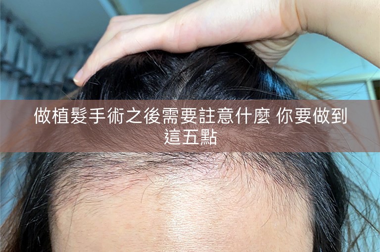 做植髮手術之後需要註意什麼 你要做到這五點