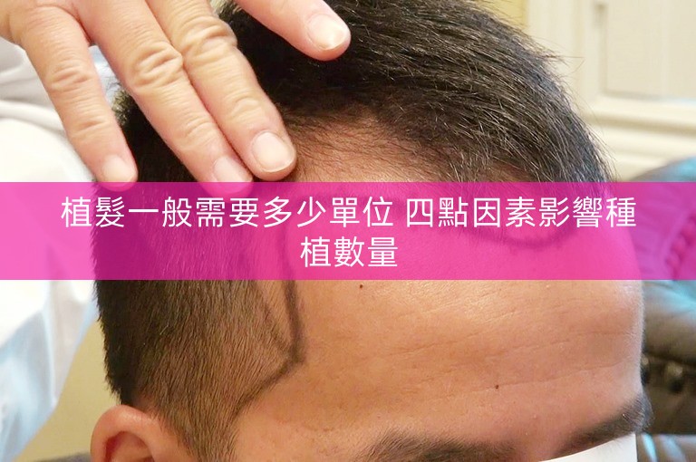 植髮一般需要多少單位 四點因素影響種植數量 植髮一般需要多少單位 四點因素影響種植數量