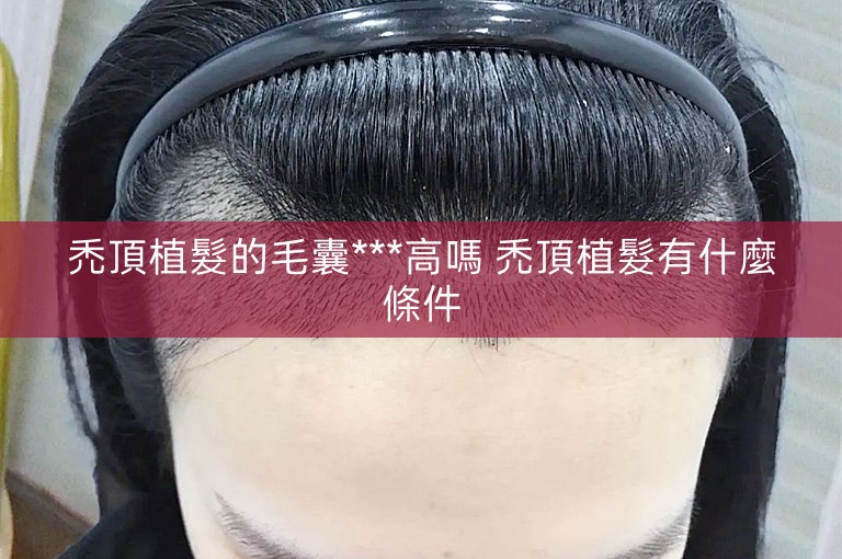 禿頂植髮的毛囊***高嗎 禿頂植髮有什麼條件 禿頂植髮的毛囊***高嗎 禿頂植髮有什麼條件