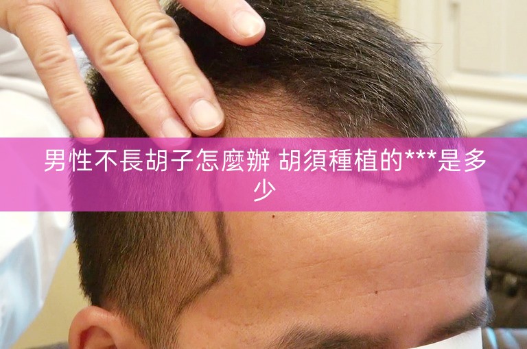 男性不長胡子怎麼辦 胡須種植的***是多少 男性不長胡子怎麼辦 胡須種植的***是多少