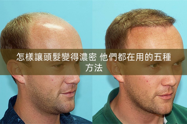 怎樣讓頭髮變得濃密 他們都在用的五種方法 怎樣讓頭髮變得濃密 他們都在用的五種方法