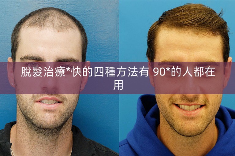 脫髮治療*快的四種方法有 90*的人都在用