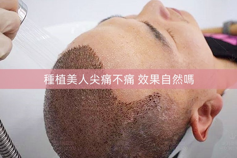 種植美人尖痛不痛 效果自然嗎