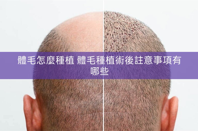 體毛怎麼種植 體毛種植術後註意事項有哪些 體毛怎麼種植 體毛種植術後註意事項有哪些