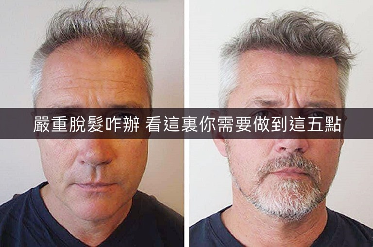 嚴重脫髮咋辦 看這裏你需要做到這五點