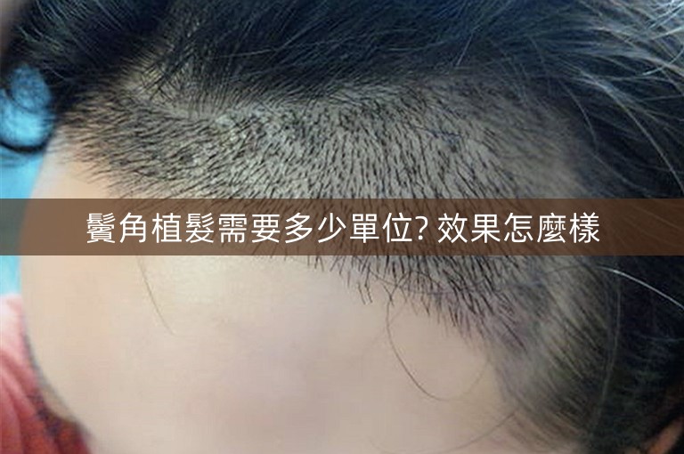 鬢角植髮需要多少單位? 效果怎麼樣