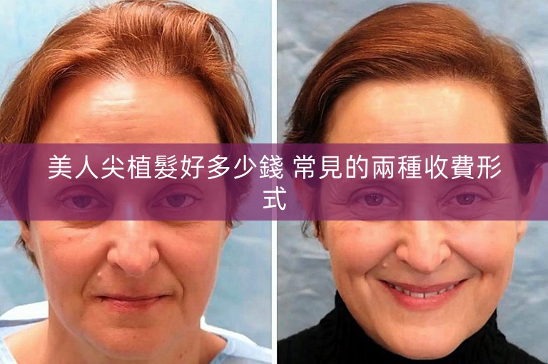 美人尖植髮好多少錢 常見的兩種收費形式