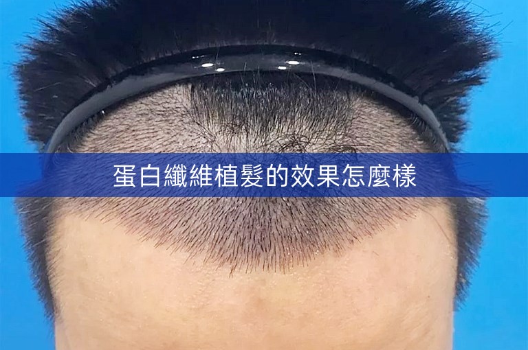 蛋白纖維植髮的效果怎麼樣