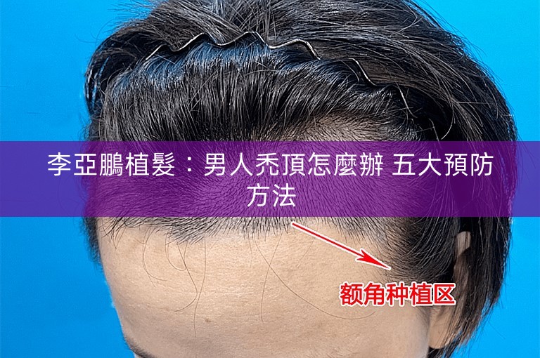李亞鵬植髮:男人禿頂怎麼辦 五大預防方法 李亞鵬植髮:男人禿頂怎麼辦 五大預防方法