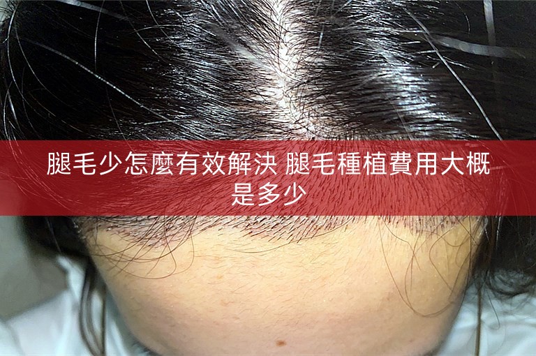 腿毛少怎麼有效解決 腿毛種植費用大概是多少